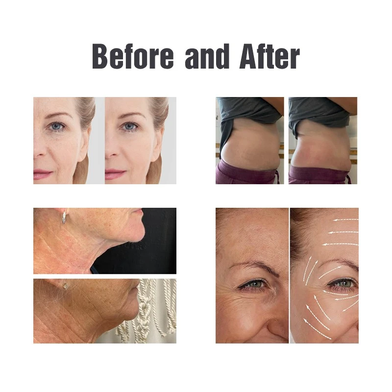Cryo Skin Tightening Machine – Triple-Action Fat Reduction & Skin Rejuvenation