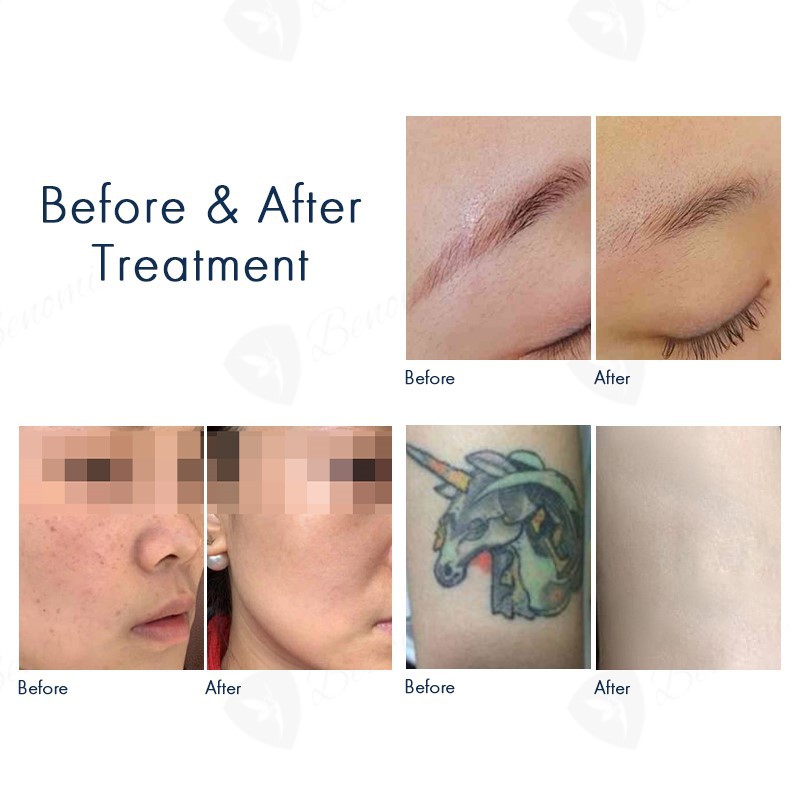 ND-YAGDiode-laser-D1-13 ND-YAGDiode-laser-D1-13